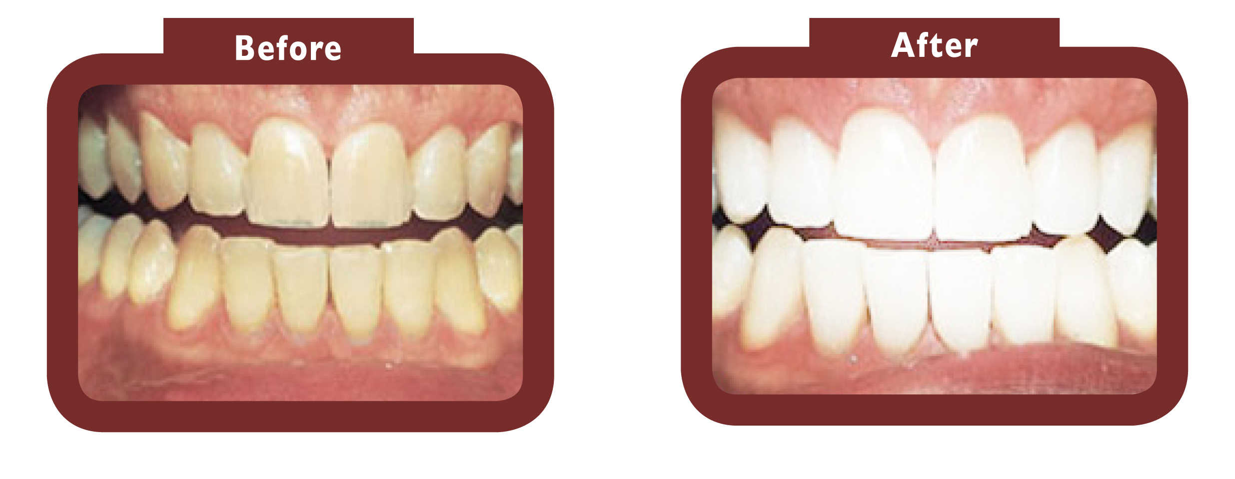 before and after teeth whitening - LA TEETH Cambridge