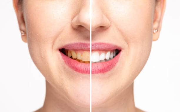 Teeth Whitening Milton Keynes Cambridge