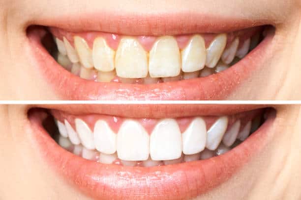 Achieve a Dazzling Smile for Your Special Day: A Guide to Wedding Teeth Whitening Cambridge