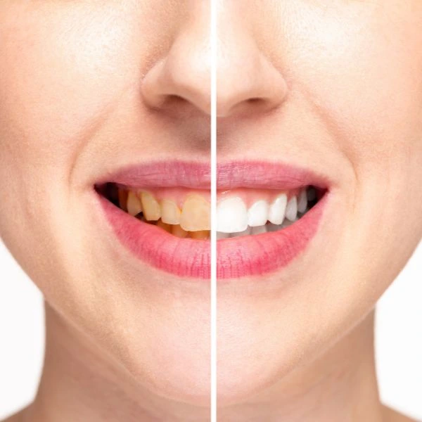 Book in for LED Light Teeth Whitening Cambridge today! Cambridge